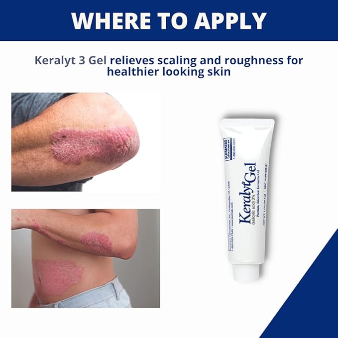 3% Salicylic Acid Gel - Exfoliating Moisturizing Skin Gel - Promotes Relief from Itchy, Redness, Dryness, Roughness, and Flakey Skin from Psoriasis, Eczema, Acne, Dermatitis