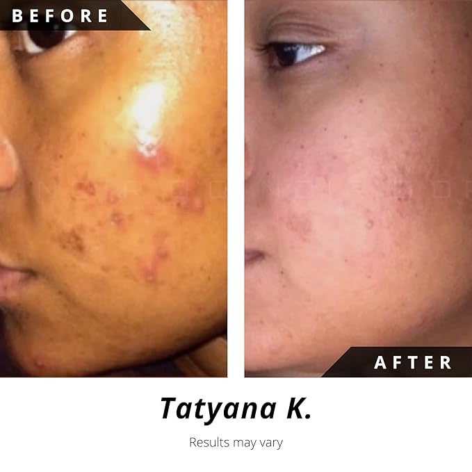 Noir D'or Acne Scar Treatment, Hyperpigmentation Treatment for Face, Normal to Oily Acne Skincare | Three Step Scar Repair Set for Acne Scars and Dark Spot Remover | Breakout Acne Treatment for Scars