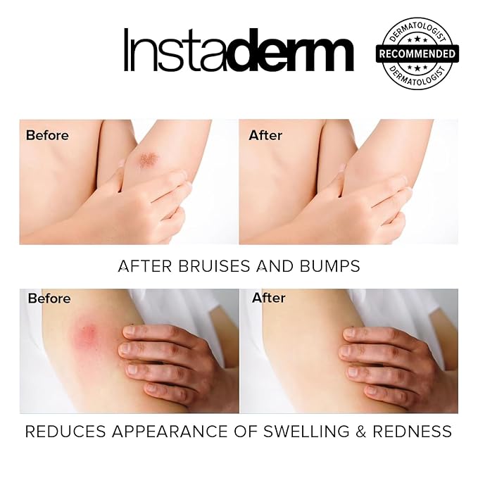 Vitamin K Cream- Bruise Healing Formula with Arnica. Dark Spot Moisturizer for Bruising, Spider Veins & Broken Capillaries. Repair Under Eye Dark Circles, & Puffiness.